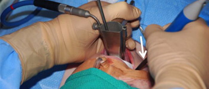 Laryngotracheal anomalies JP Nagar