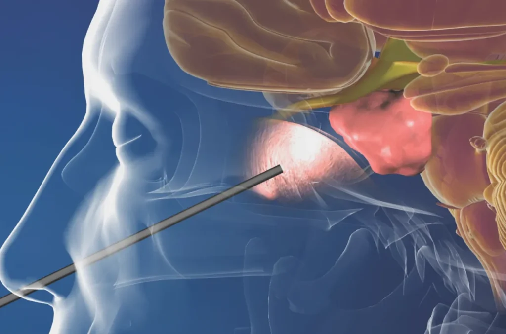 Anterior skull base surgery in Kanakapura Road
