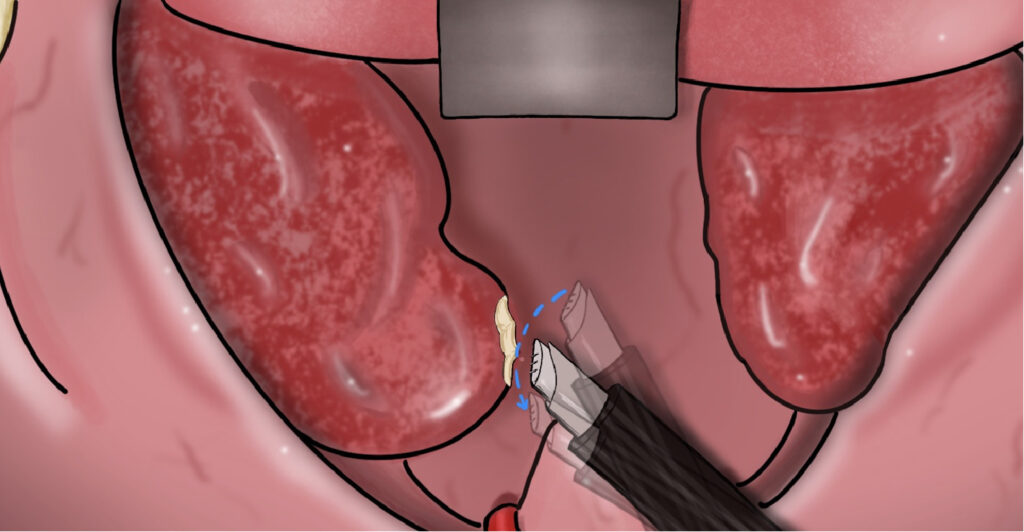 Coblation tonsillectomy Bangalore