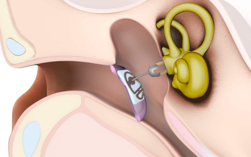 PORP and TORP ossicular prosthesis used in ossiculoplasty Jayanagar