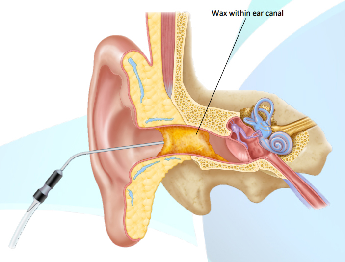 ENT surgeon performing ear micro surgery under operating microscope Jayanagar Bangalore