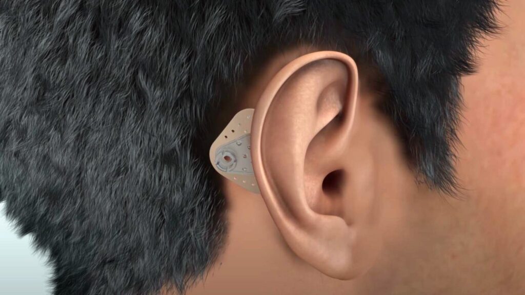 Adhear non-surgical bone conduction hearing device Jayanagar Bangalore clinic