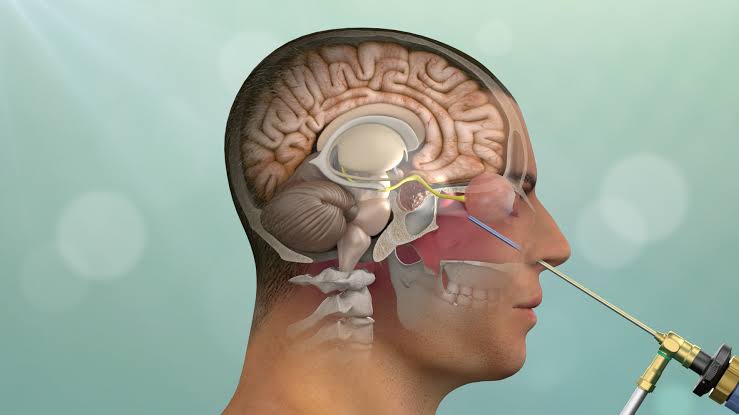 Endoscopic CSF leak repair procedure at Jayanagar ENT clinic Bangalore