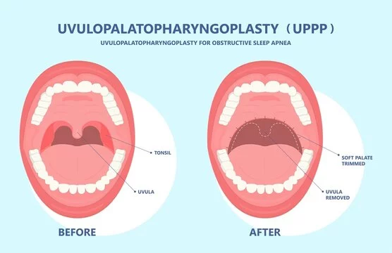 ENT surgeon examining patient's throat before UPPP surgery in Jayanagar Bangalore