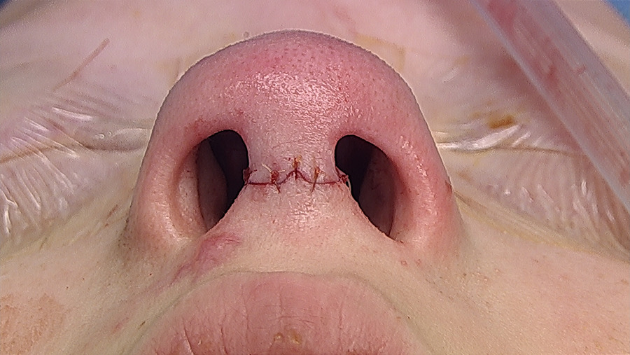 pediatric septoplasty Kanakapura Road