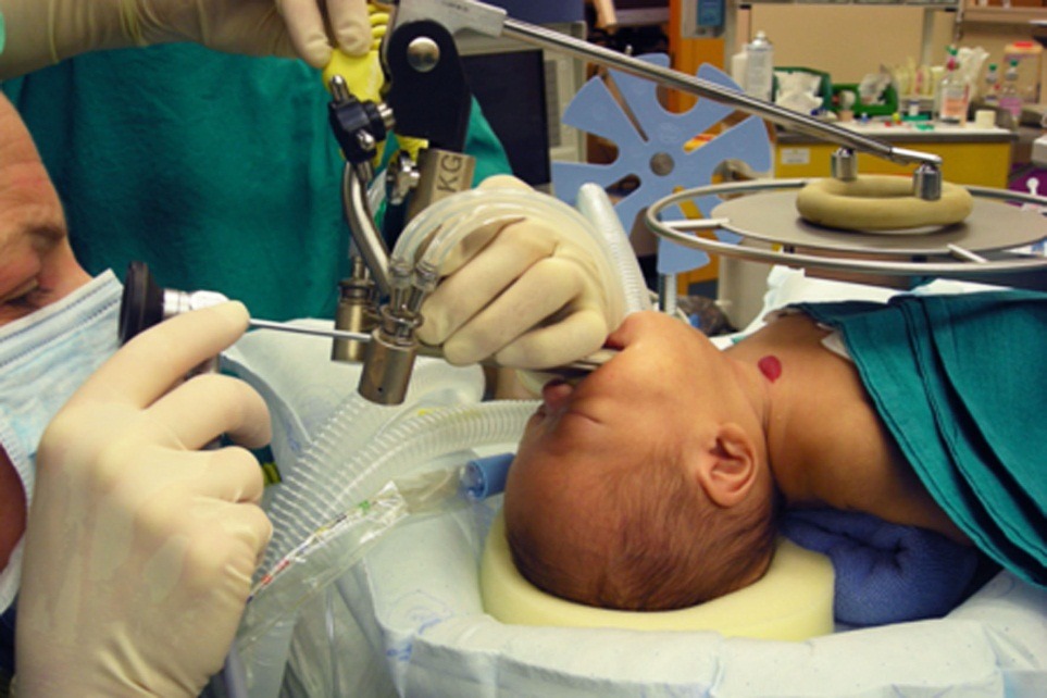 Surgeon performing microscopic voice surgery under operating microscope in Bangalore