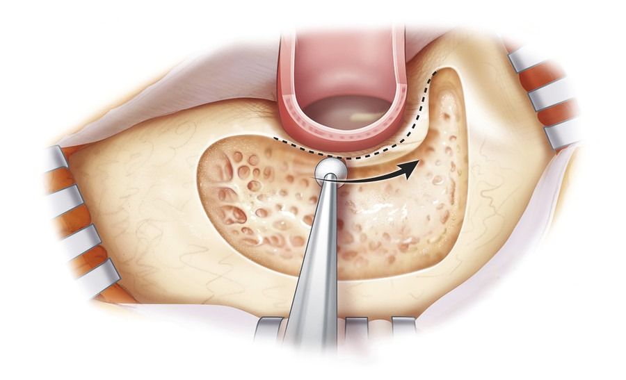 Mastoid bone anatomy behind the ear illustration Bangalore ENT