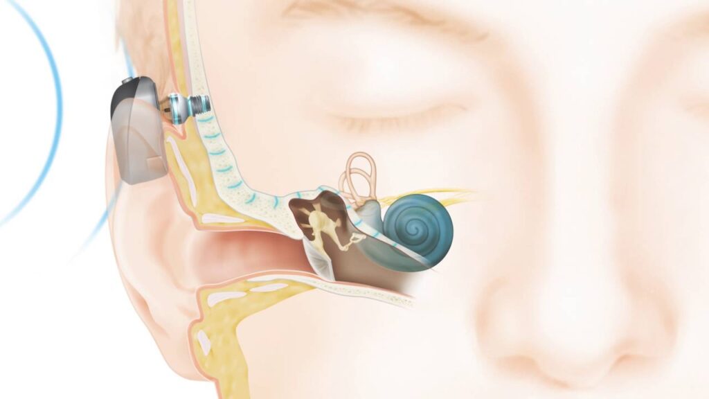 Bone conduction implant device fitted at ENT clinic Jayanagar Bangalore