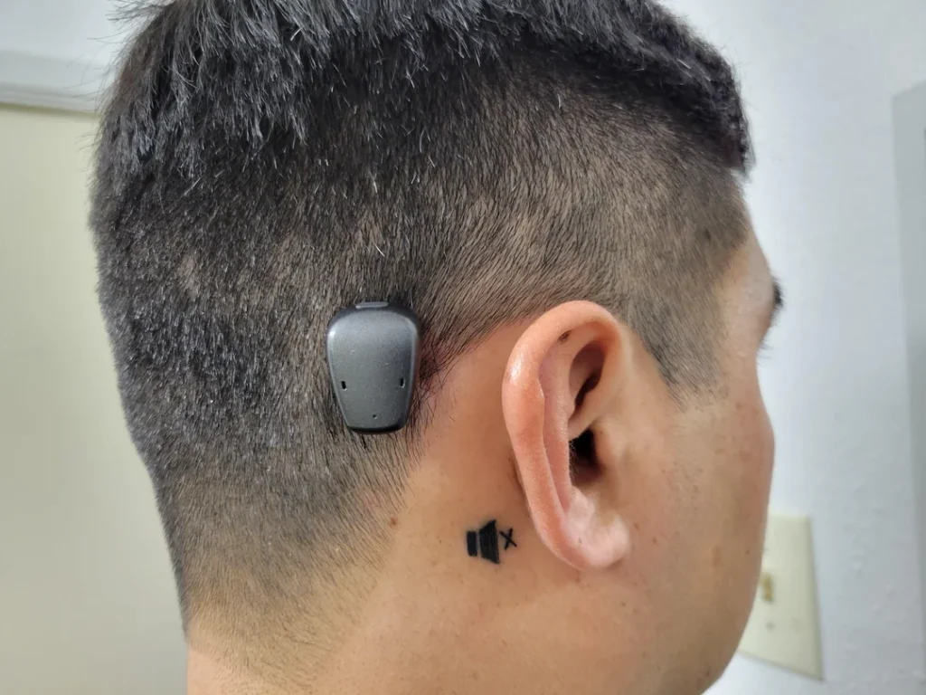 Bone conduction implant BAHA surgery being explained at Dr. Rohit's ENT clinic Jayanagar Bangalore