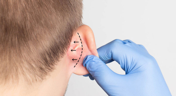 Otoplasty consultation for prominent ear correction in Jayanagar Bangalore