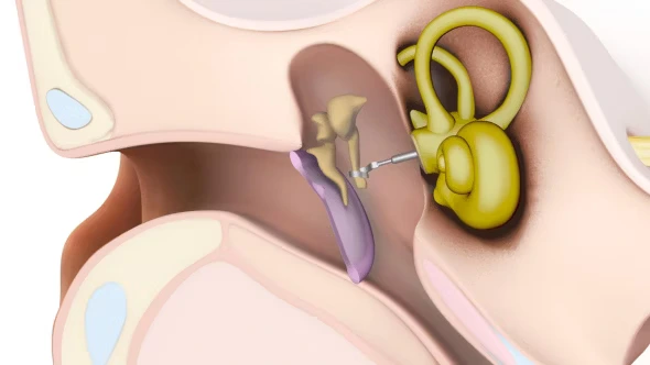 Middle ear implant device consultation at ENT clinic Jayanagar Bangalore