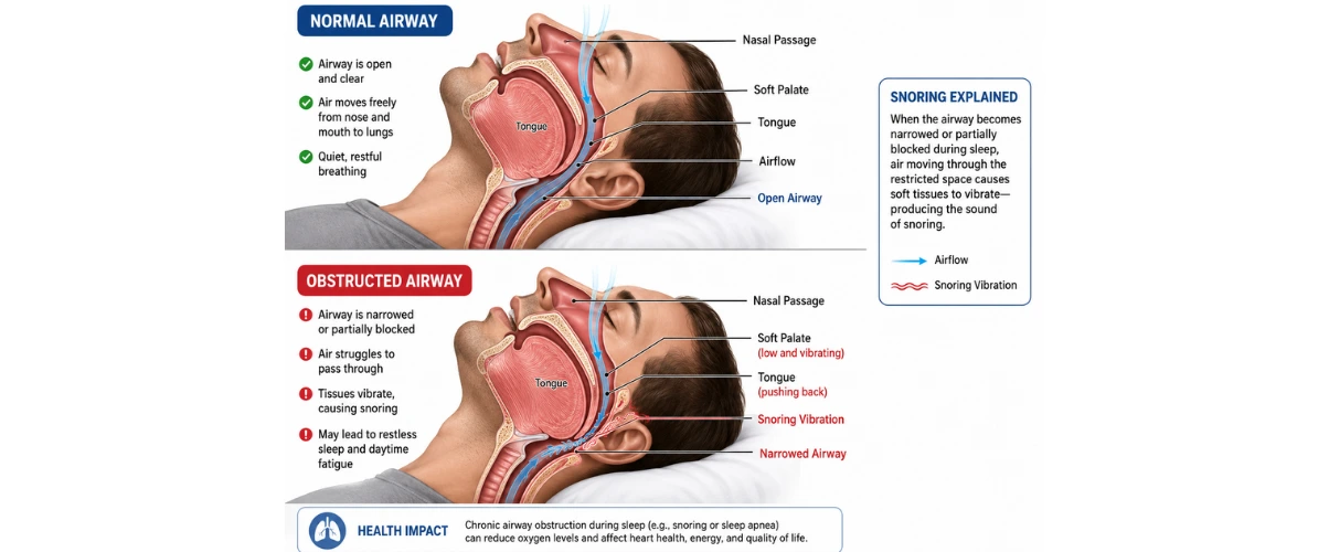 Illustration of upper airway obstruction causing snoring